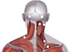 Localization of typical muscle pain points in trauma (injury) or chronic overload of muscles and ligaments of the neck.