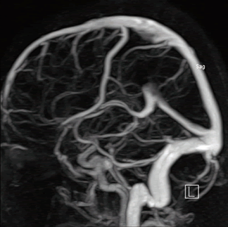Диагностика магнитно-резонансная ангиография сосудов головного мозга производится при подозрении на тромбофлебит сигмовидного синуса.