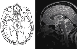 Магнитно-резонансная томография головного мозга (МРТ), показаны срезы третьего и четвёртого мозговых желудочков.