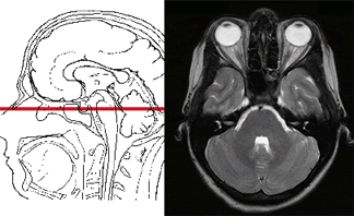 Магнитно-резонансная томография (МРТ) головного мозга в аксиальной плоскости назначают при некоторых его заболеваниях.