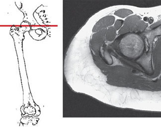 Магнитно-резонансная томография (МРТ) тазобедренного сустава в аксиальной плоскости (связки, суставной хрящ) при остеоартрозе (коксартрозе).