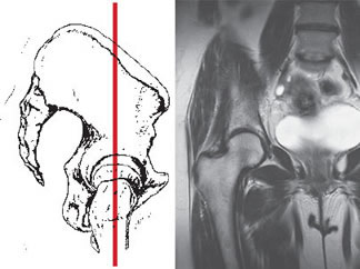 Магнитно-резонансная томография (МРТ) тазобедренного сустава во фронтальной плоскости (связки, суставной хрящ) при остеоартрозе (коксартрозе).