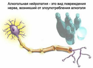 Алкогольная полиневропатия (полиневрит) поражает периферические нервы нижних конечностей.