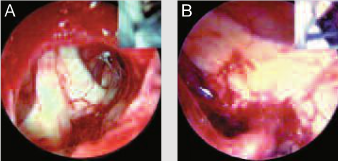 Рис 3. Эндоскопическое изображение перекреста зрительных нервов (А) и гипофизарной ножки (В) после микрохирургического удаления большой аденомы через трансфеноидальный доступ.