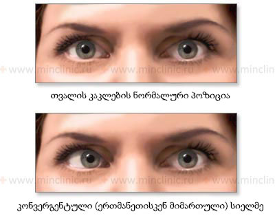 ნაჩვენებია თვალის კაკლების ნორმალური პოზიცია და კონვერგენტული (ერთმანეთისკენ მიმართული) სიელმე მარჯვენა თვალის ლატერალური (გარეთა) სწორი კუნთის სისუსტის დროს (VI წყვილი).