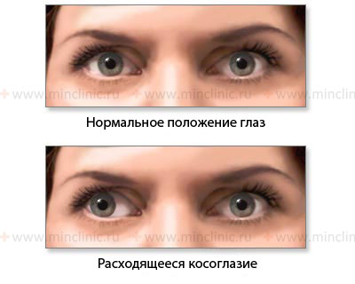 Shows the normal position of the eyeballs and divergent strabismus with weakness of the medial (internal) rectus muscle of the eye on the right (n. Oculomotorius, III pair).