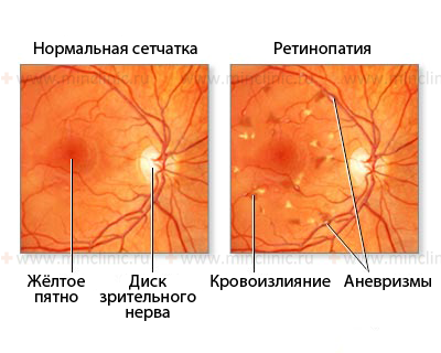 Изменения вокруг жёлтого пятна (кровоизлияния, аневризмы сосудов сетчатки) при ретинопатии.