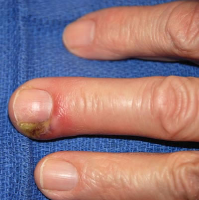 Cutaneous panaritium of the lateral edge of the nail bed. Edema, hyperemia and abscess formation of the soft tissues of the finger are visible.