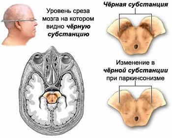 Зона поражения чёрной субстанции ствола головного мозга при болезни Паркинсона или паркинсонизма.