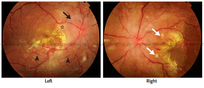არტერიული ჰიპერტენზიის მქონე პაციენტებში თვალის ფსკერის გამოკვლევის დროს ავლენენ ორმხრივი მხედველობის ნერვების დისკოების შეშუპებას (შავი ისარი), მაკულარულ შეშუპებას ლიპიდურ ექსუდატთან (ვარსკვლავი) ერთად, წერტილოვან (პეტიხიულ) სისხლჩაქცევებს (პატარა შავი ისრები) და ბამბისებრ ლაქებს (თეთრი ისრები).