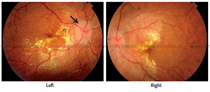 После 1 месяца лечения артериальной гипертензии у того же пациента при исследовании глазного дна выявляется полное разрешение отёка диска зрительного нерва (черная стрелка) и макулярного отёка (звездочка).