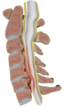 Стеноз позвоночного канала при спондилёзе со сдавлением спинного мозга на уровне шейного отдела позвоночника с гипертрофией задней продольной и жёлтой связки.