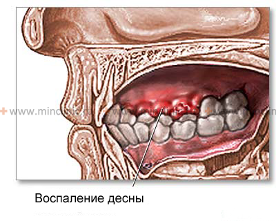 При осмотре полости рта с язвенным гингивитом обнаруживается десневой край покрытый серым зловонным налётом, после удаления, которого обнажается кровоточащая резко болезненная поверхность.