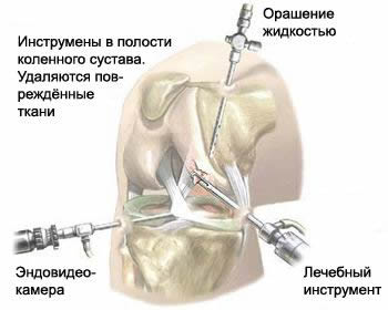 Endoscopic (arthroscopic) surgery on the knee joint with rupture of ligament and meniscus.