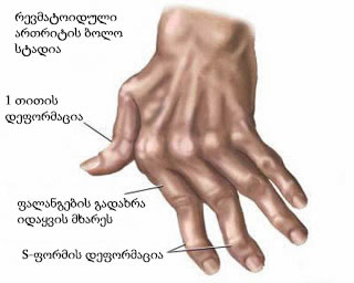 ხელის მტევნის თითების ფალანგების ტიპური დეფორმაცია რევმატოიდული ართრიტის დროს.