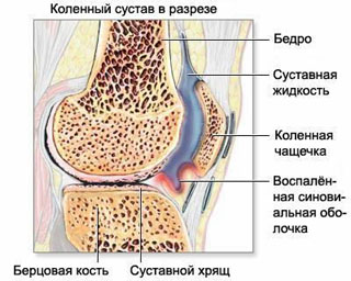 Osteoarthrosis (gonarthrosis) of the knee joint (ligaments, meniscus, articular cartilage).