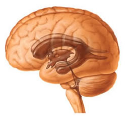 The normal circulation of cerebrospinal fluid (CSF) is restricted by arachnoiditis.