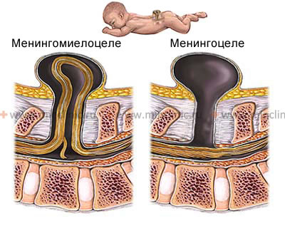 The hernial protrusion with the spina bifida is filled either by the membranes of the spinal cord (meningocele) or will also include a portion of the spinal cord (meningomyelocele).