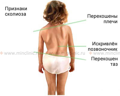 Искривление оси позвоночного столба у ребёнка со сколиозом грудного и поясничного отдела позвоночника.