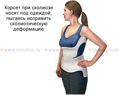 Wearing a special corset for scoliosis and impaired posture.