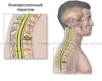 Компрессионный перелом тела позвонка грудного отдела позвоночника.