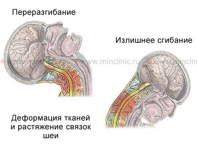 Механизм формирования компрессионного перелома тел позвонков с сопутствующим хлыстовым растяжением мышц и связок шейного отдела позвоночника.