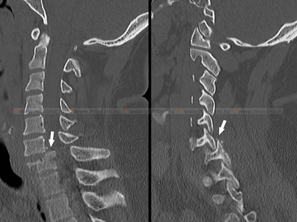 КТ шейного отдела позвоночника выявляет перелом с вывихом C7 позвонка, сцепление фасеточных суставов.