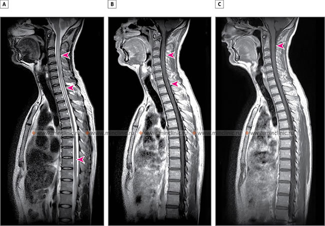 A - MRI of the spinal cord in the sagittal plane (T2 mode) revealed a hyperintense lesion of the spinal cord with edema in the redistribution of C2-C5 and C7-Th3 segments (indicated by arrows). B - MRI of the spinal cord with contrast (T1 mode) reveals an uneven point accumulation of contrast in the spinal cord (indicated by arrows). C - The almost complete restoration of the morphological picture of the spinal cord affected by sarcoidosis after treatment with corticosteroids (indicated by an arrow).
