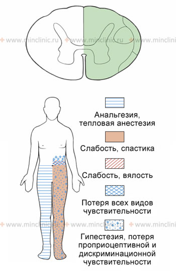 Синдром броун секара это. Синдром половинного поражения спинного мозга Броун Секара. Синдром Броун Секара спинной мозг. Синдром Броун Секара неврология. Синдром Броун Секара схема.