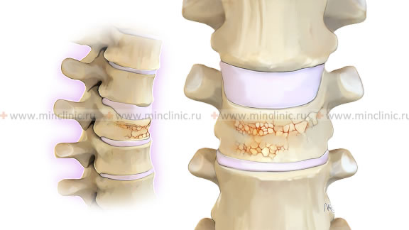 Compression fracture of the vertebral body.