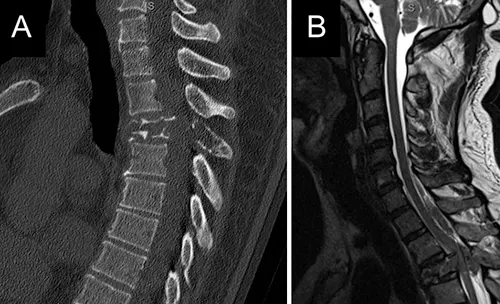 Multiple Myeloma Vertebral Fracture CT and MRI images showing a pathological fracture and spinal cord compression due to multiple myeloma at the T3 level.