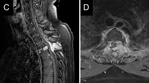 Multiple Myeloma Epidural Extension Contrast-enhanced MRI showing epidural tumor extension from T1-T4 causing thecal sac and spinal cord compression in multiple myeloma.