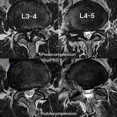 MRI of the lumbar spine shows spinal stenosis and post-endoscopic decompression at the L3-L4 and L4-L5 levels.