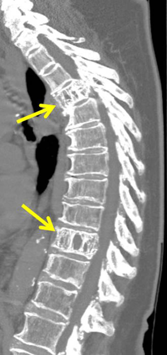 Computed tomography of the spine (CT) in aggressive hemangioma shows vertical lines that have the appearance of "corduroy tissue", "bars" or "honeycomb" on sagittal images (arrows).